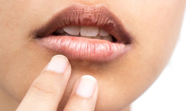 Cara mengatasi bibir hitam